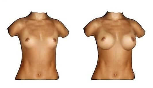 MyBreast 4D Augmented Reality Imaging Scan