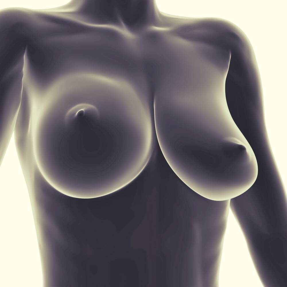 Guide to Micromastia and breast asymmetry