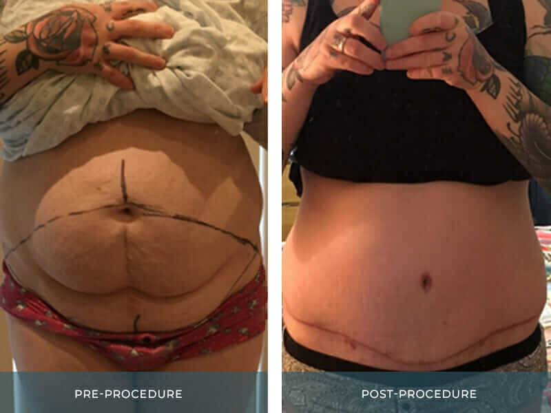 MyBreast Tummy Tuck Before and After