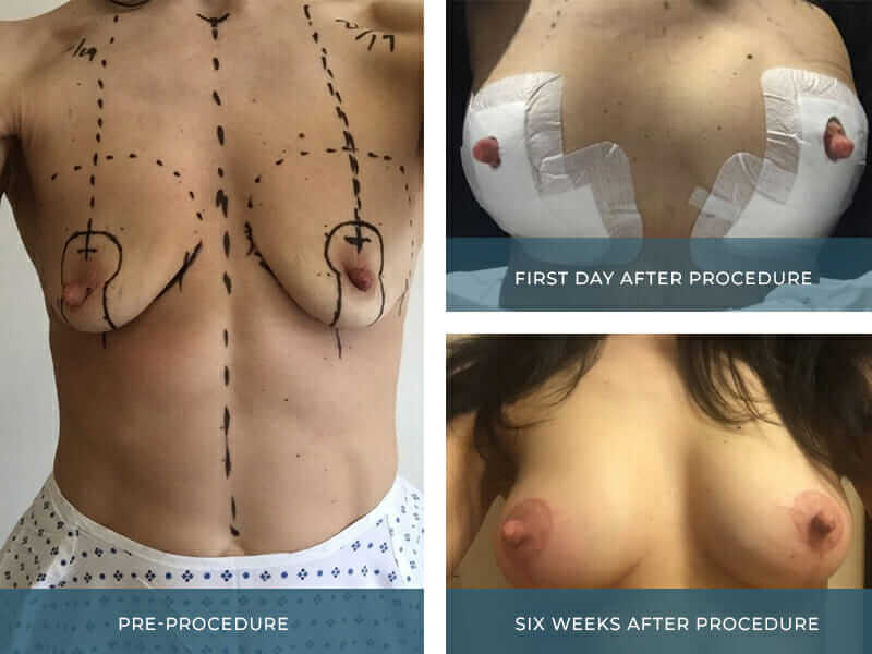 Gabriela's Breast Uplift with Implants recovery story