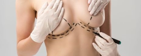 MyBreast Breast Uplift with Implants Mastopexy