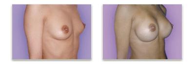 small breast before and after