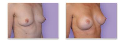 small breast before and after